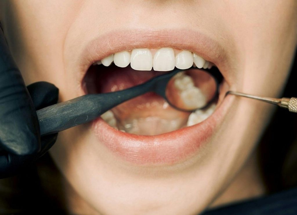 Causes of Dental Crown Discomfort