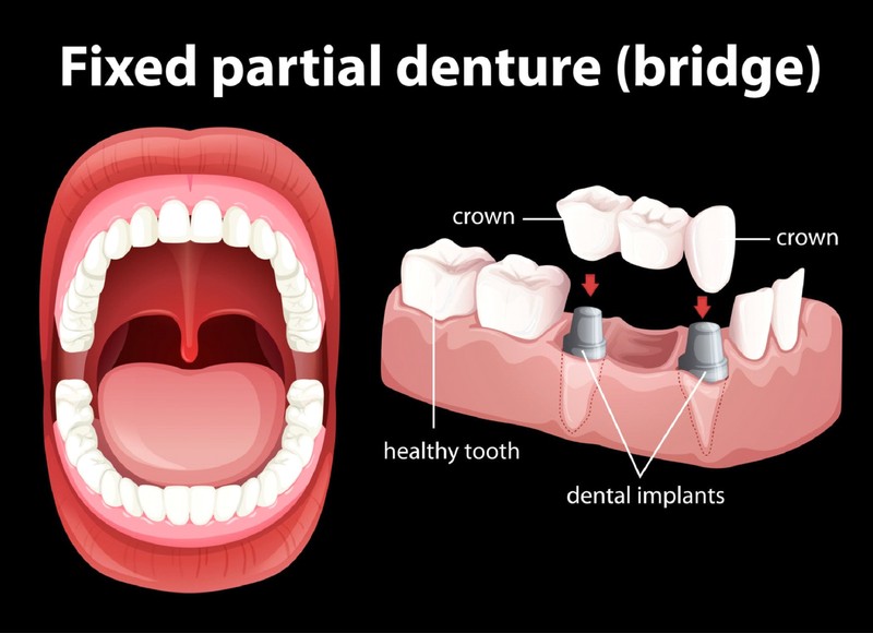 Restoring Your Smile: Dentures in Lakewood, CO