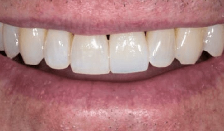 after dental implant