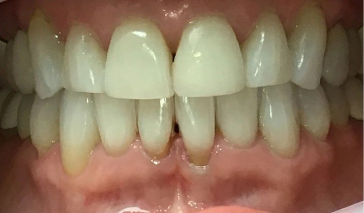 patient teeth after treatment