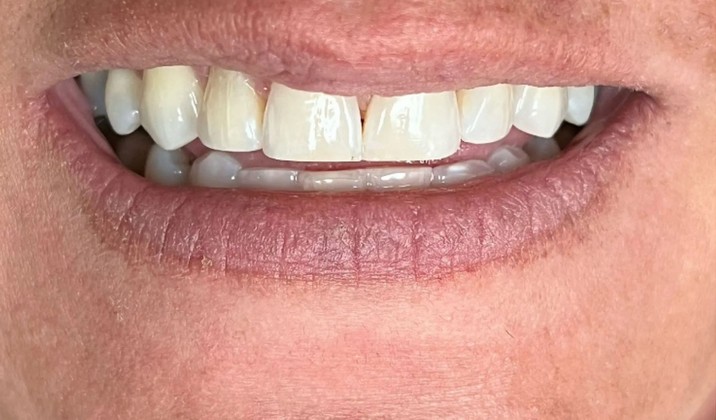 patient teeth after treatment