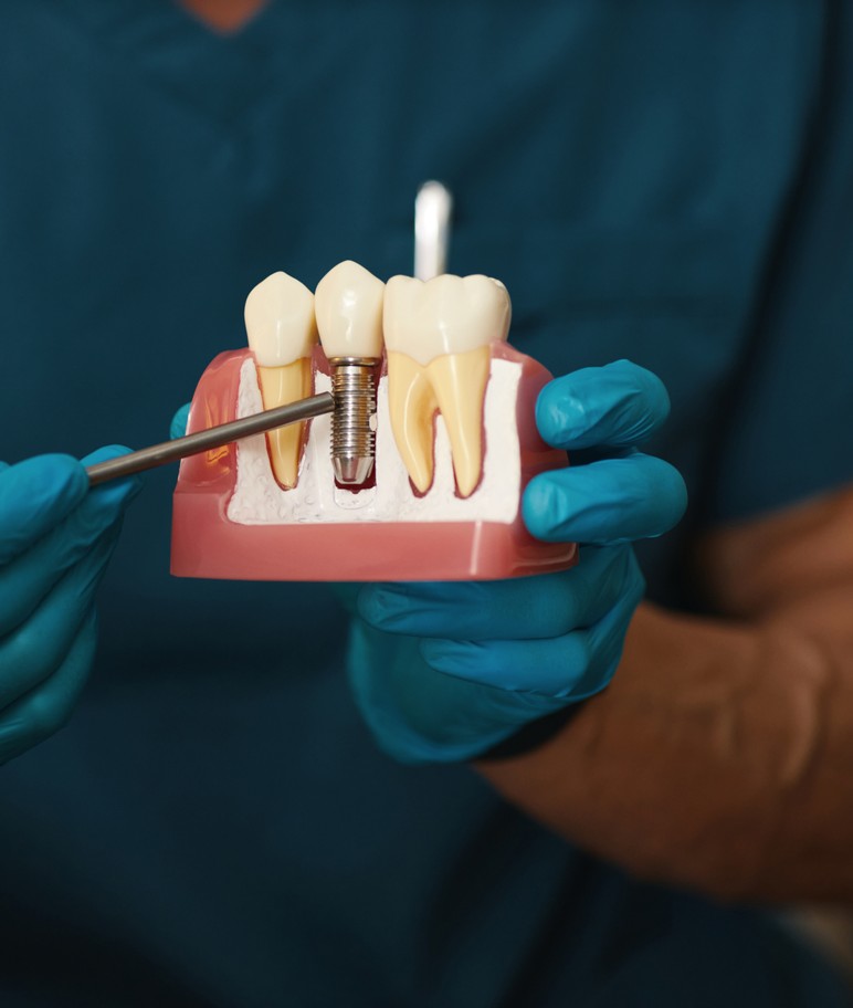 dental implant model