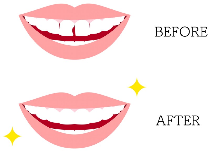 Professional Teeth Whitening in Lakewood, CO