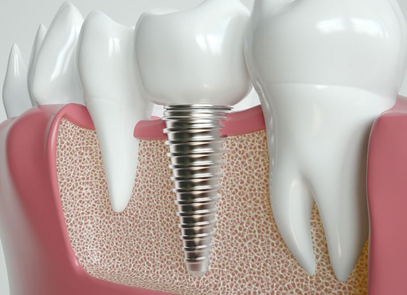 Restore Your Smile with Dental Implants