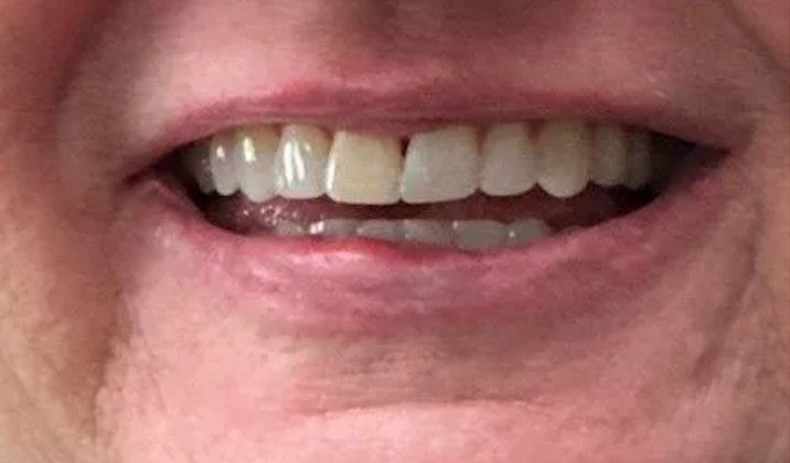 patient teeth after treatment