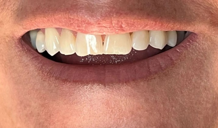 patient teeth before treatment