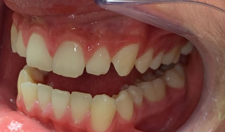 patient teeth after treatment