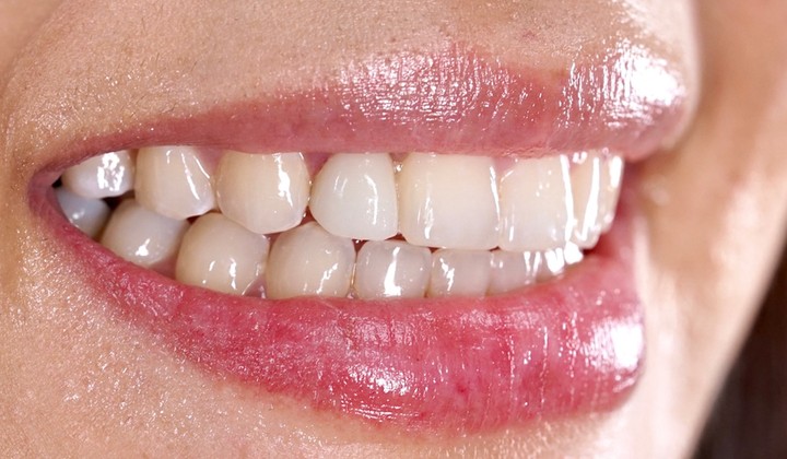 after dental implant