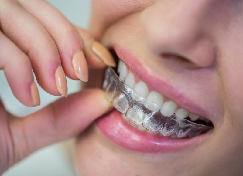 Invisalign & Speech Problems: How Aligners Help