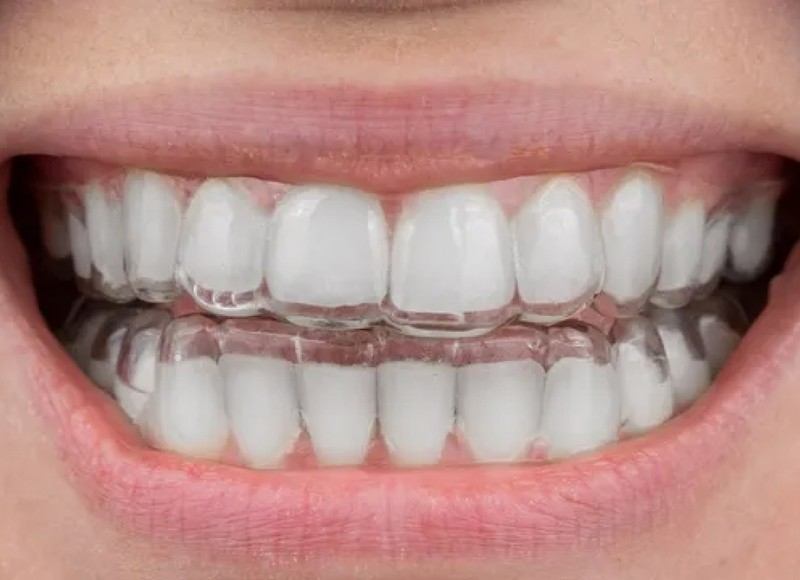 Invisalign for Adults: A Clear Path to Your Smile