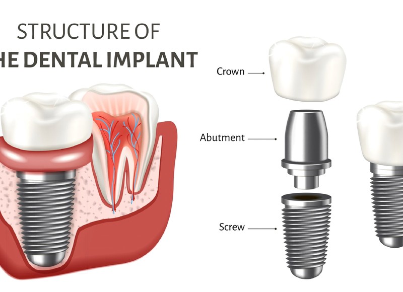 The Complete Guide to Dental Implants in Lakewood, CO | Dr. Raines