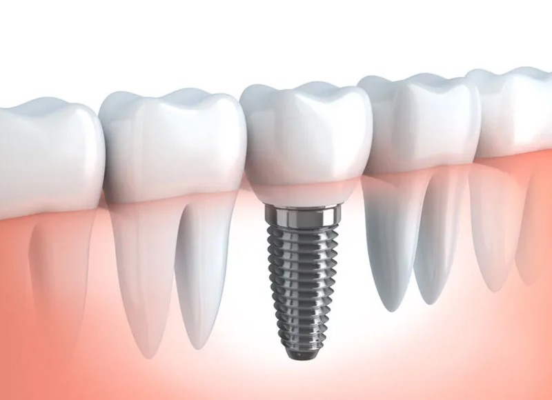 Dental Implants: A Superior Choice in Lakewood
