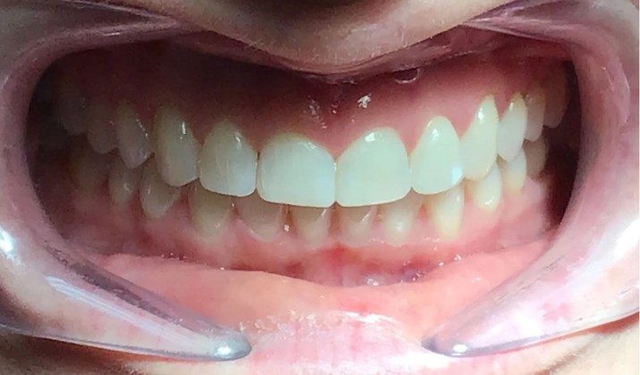 patient teeth after treatment