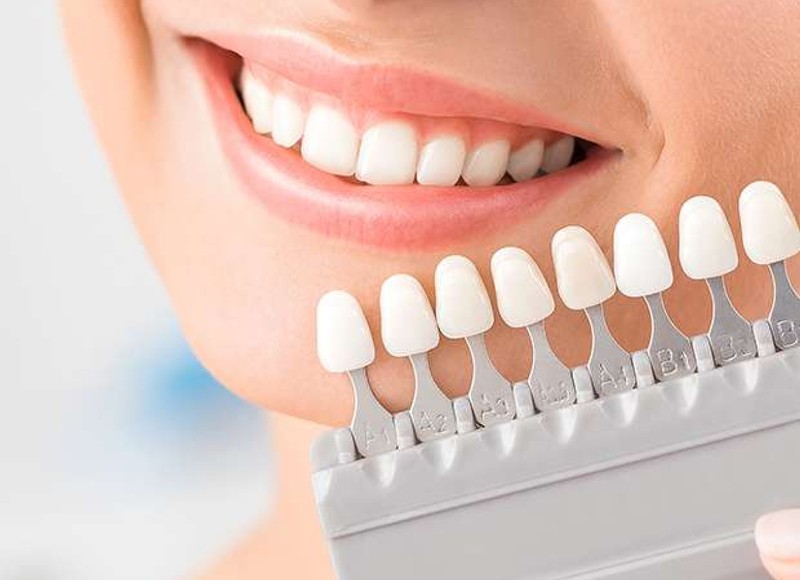 Caring for Porcelain Veneers Over Time