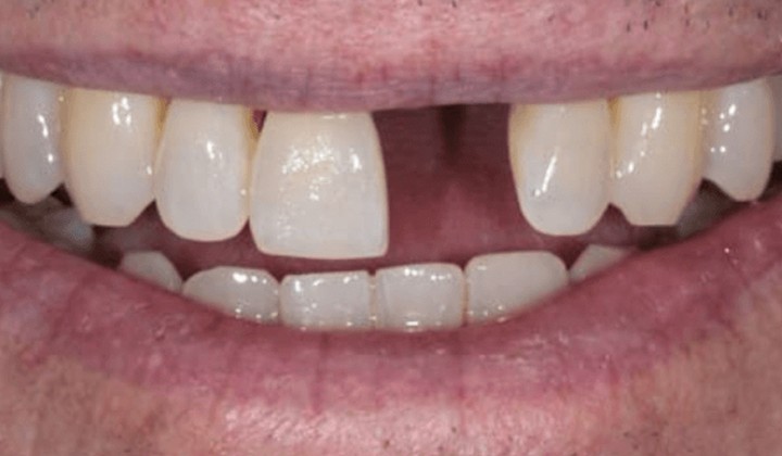 before dental implant