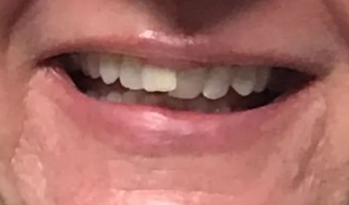 patient teeth before treatment