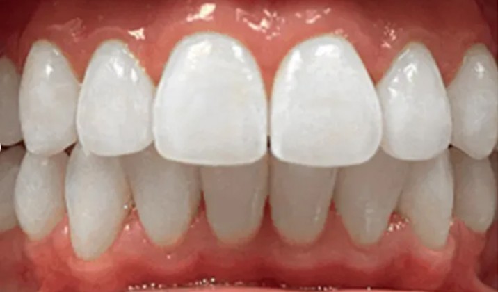 patient teeth after treatment