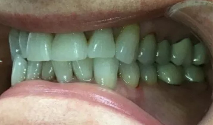 patient teeth before treatment