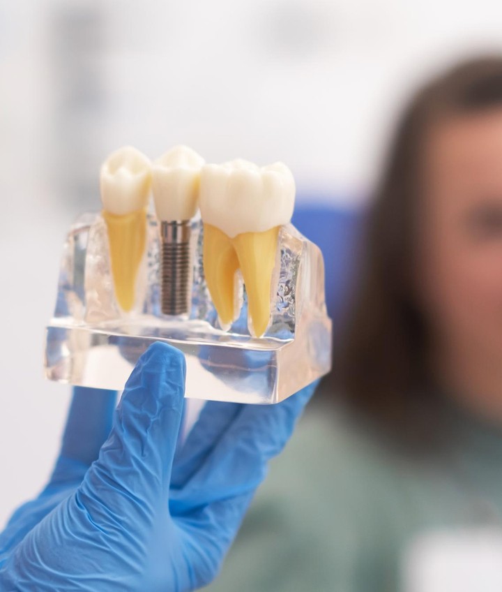 dental implant model