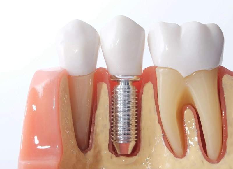 4 Benefits of Dental Implants