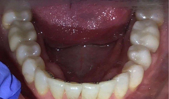 patient teeth after treatment