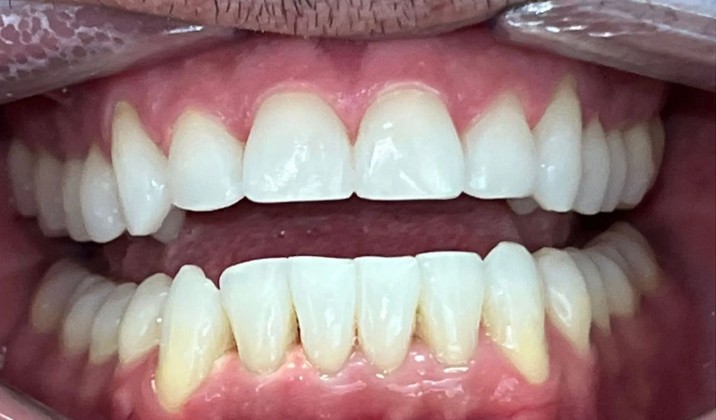 patient teeth after treatment