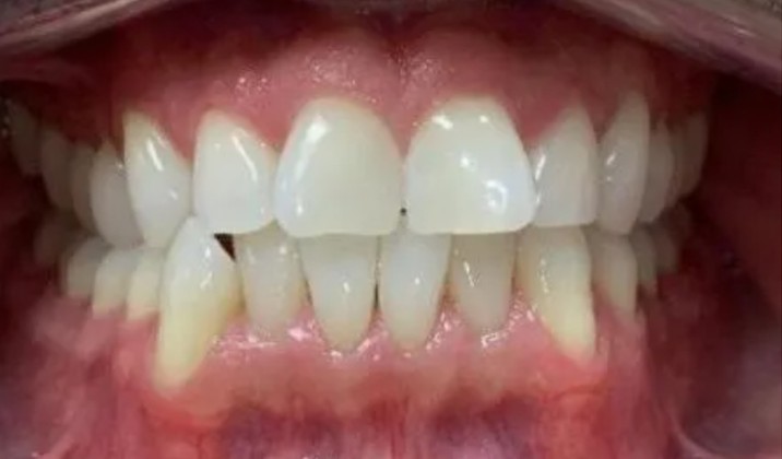 patient teeth before treatment