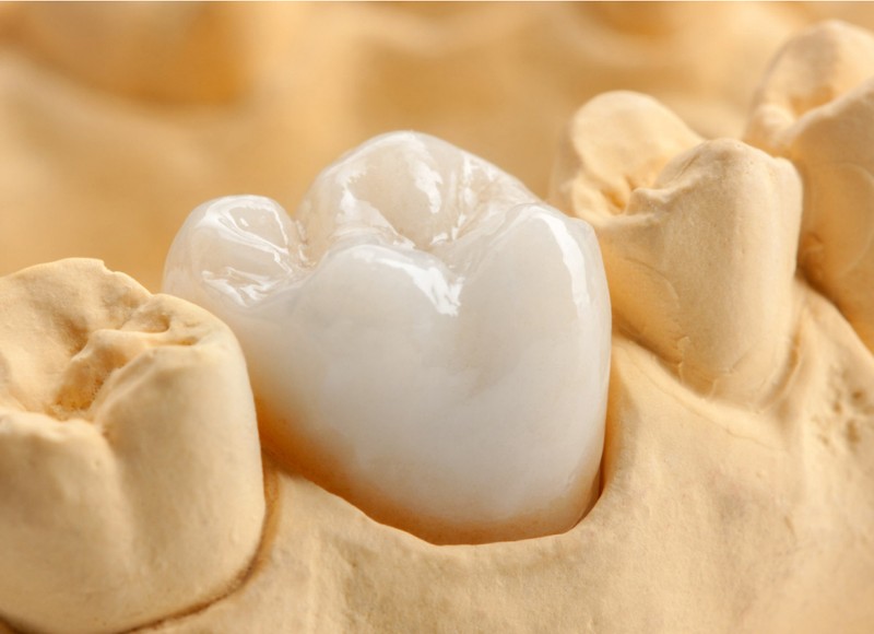 Managing Discomfort from Dental Crowns