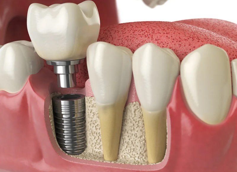 After Dental Implants: What to Expect