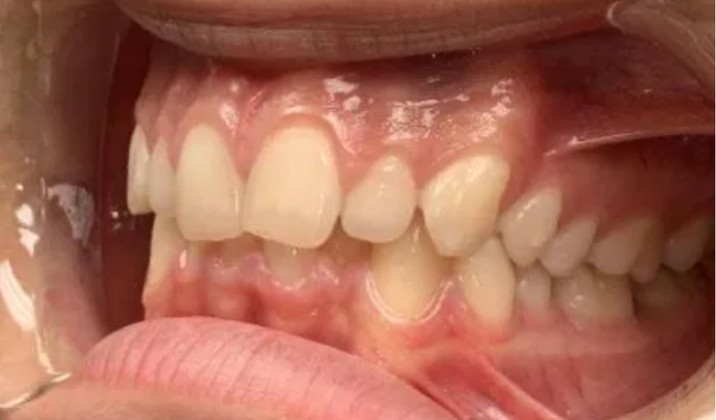 patient teeth before treatment