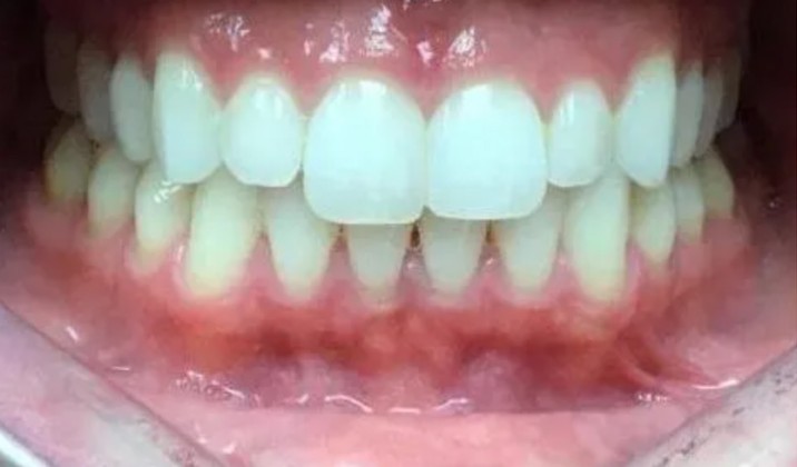 patient teeth before treatment