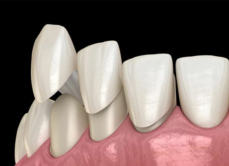 The Art of the Smile Makeover: Custom Cosmetic Dentistry in Lakewood