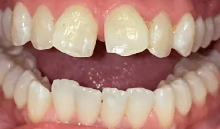 patient teeth before treatment