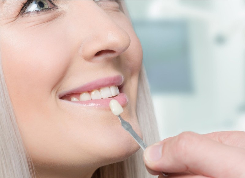 When to Consider Same Day Porcelain Veneers