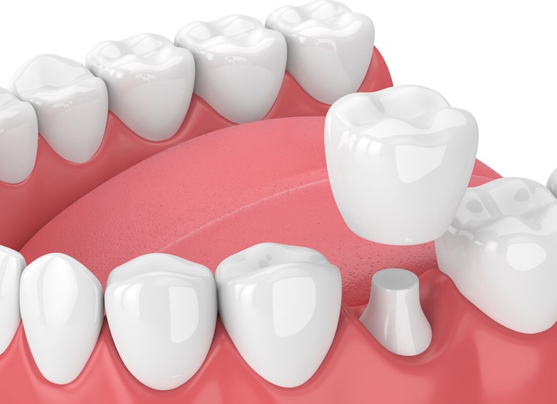 What to Do If Your Dental Crown Falls Off