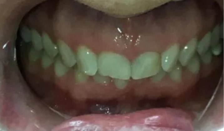 patient teeth before treatment