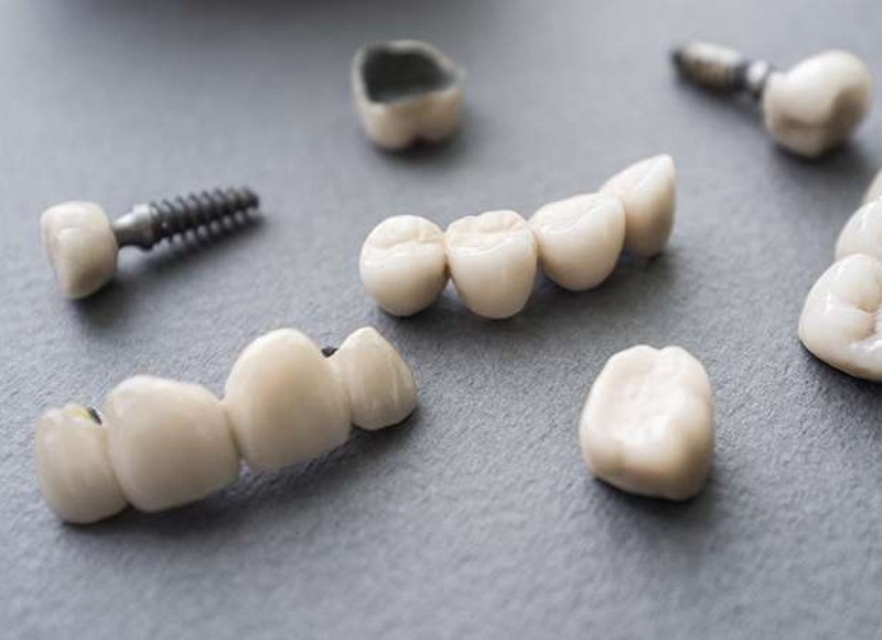 Why Choose Dental Implants in Lakewood